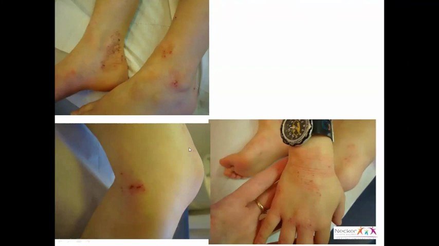Lésions d'eczéma atopique aux plis (poignet, cheville, genou)