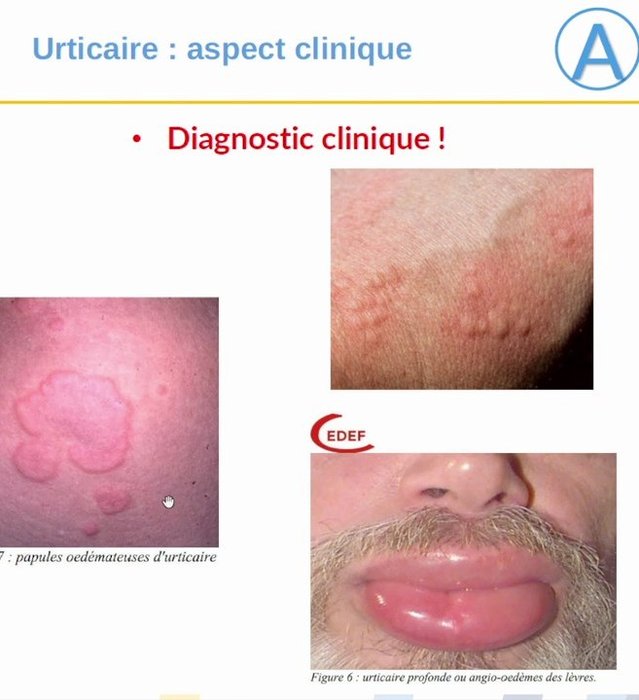 Papules œdémateuses d'urticaire et angio-œdème des lèvres