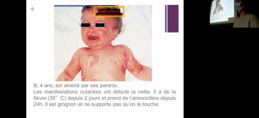 Exanthème maculo-papuleux du tronc chez un enfant sous amoxicilline depuis 24h