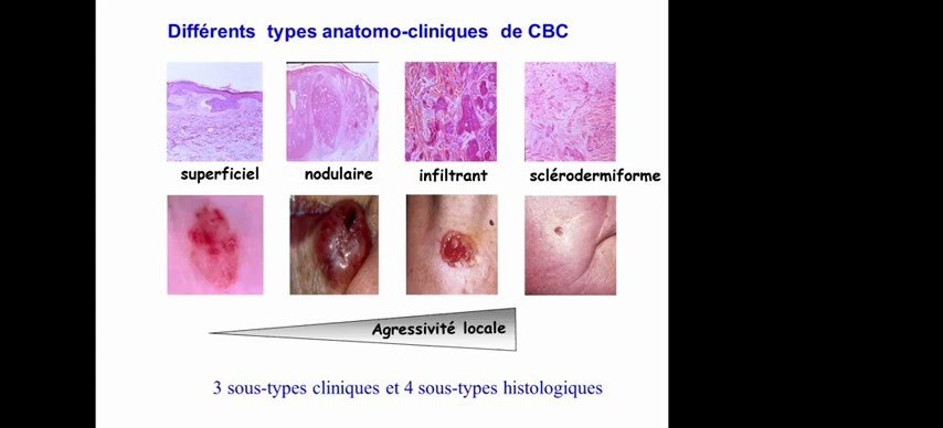 Les 4 sous-types histologiques et cliniques de carcinome basocellulaire