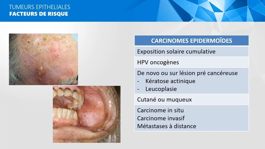 Kératoses actiniques diffuses du cuir chevelu et lésion précancéreuse muqueuse buccale