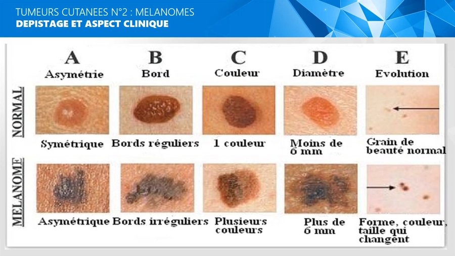 Règle ABCDE comparant un grain de beauté normal et un mélanome