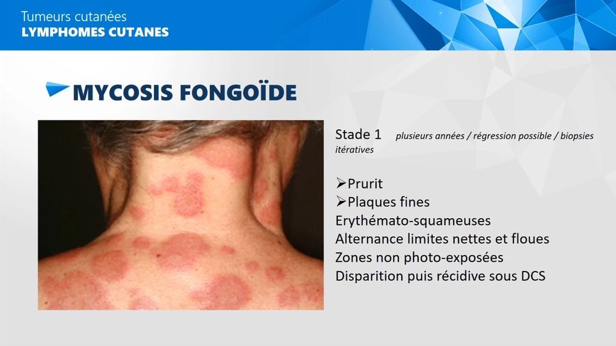 Mycosis fongoïde stade 1 : plaques érythémato-squameuses fines de la nuque et du dos