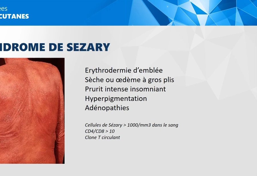 Érythrodermie diffuse du dos dans le syndrome de Sézary