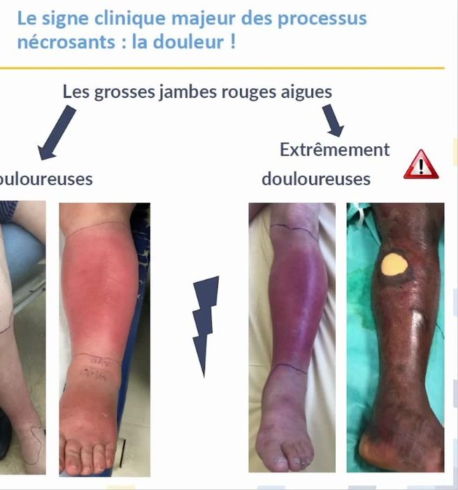 Comparaison d'une jambe douloureuse (érysipèle) et d'une jambe extrêmement douloureuse avec nécrose (fasciite nécrosante)