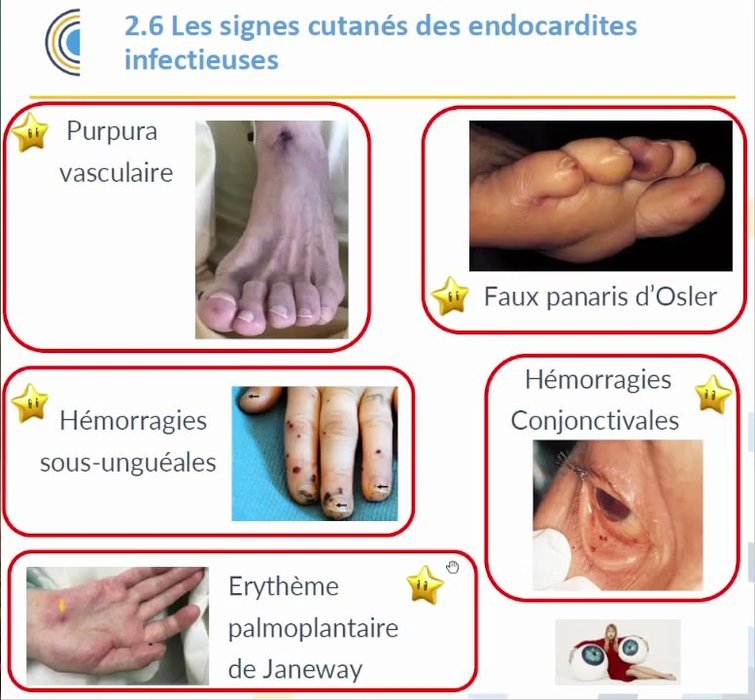 Purpura vasculaire du pied, faux panaris d'Osler, hémorragies sous-unguéales, hémorragie conjonctivale et érythème de Janeway
