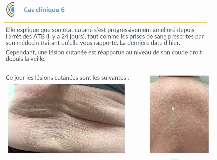 Lésions cutanées résiduelles au coude et au dos après un DRESS syndrome