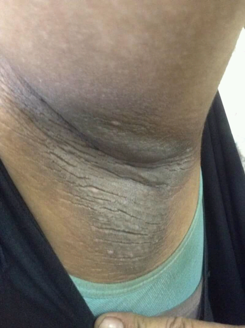 Acanthosis nigricans