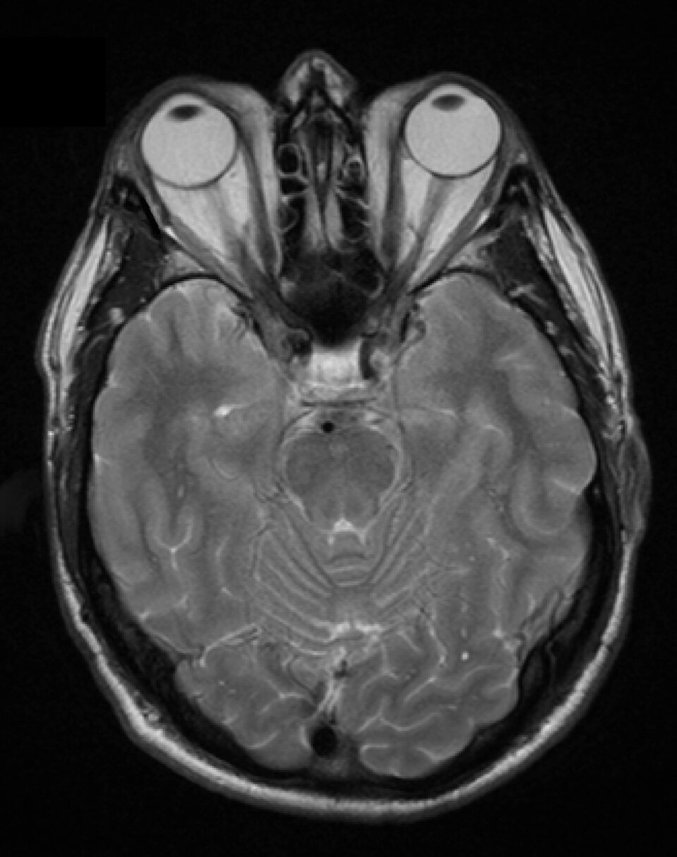 Exophtalmie (Basedow)