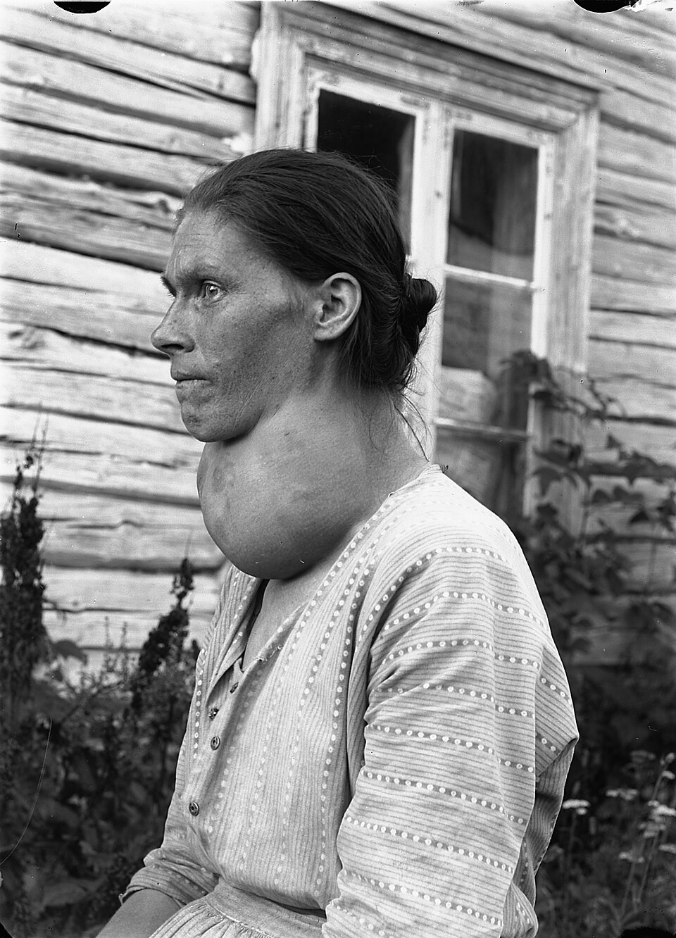 Palpation d'un goitre thyroïdien