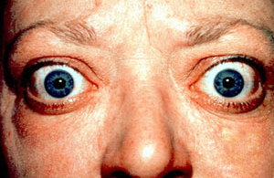 Hyperthyroïdie (Basedow)