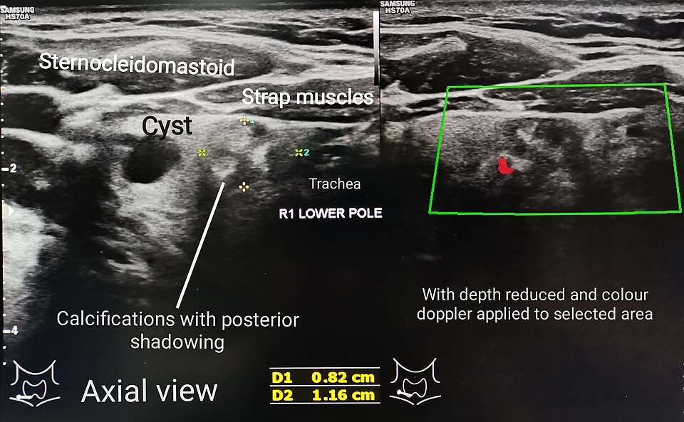 Nodule thyroïdien