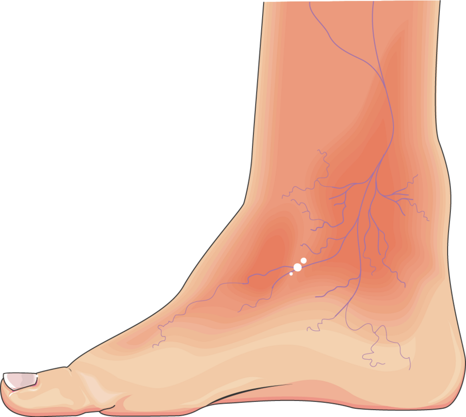 Examen du pied diabétique