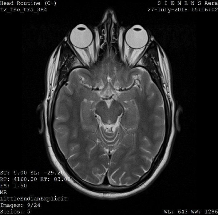 Des complications iatrogènes à anticiper systématiquement