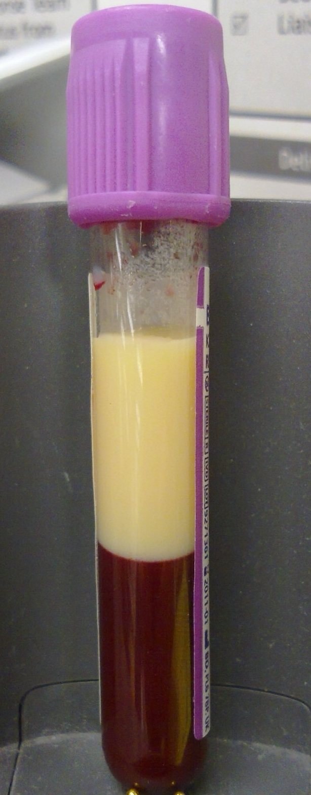 Sérum lactescent (hypertriglycéridémie majeure)