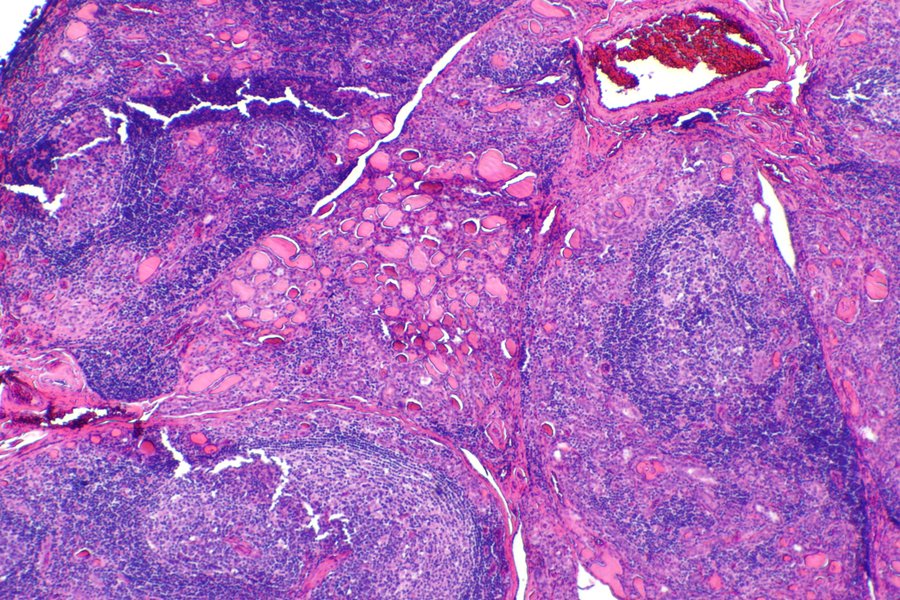 Une thyrotoxicose par destruction plutôt que par hyperproduction