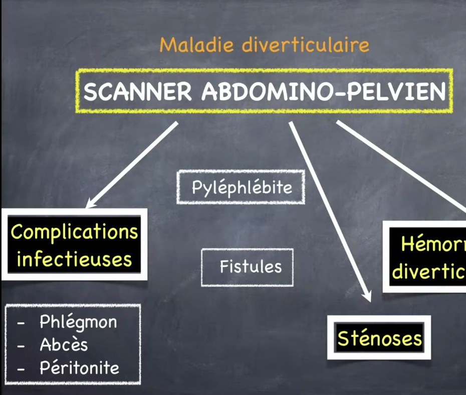 Diverticulose Colique et Diverticulite