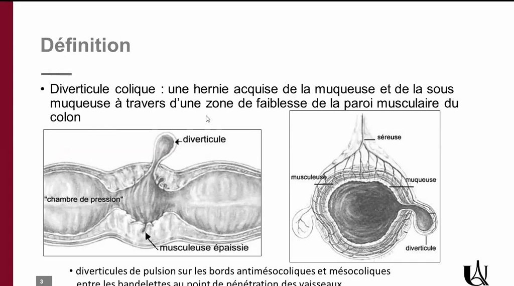 Diverticulose Colique et Diverticulite