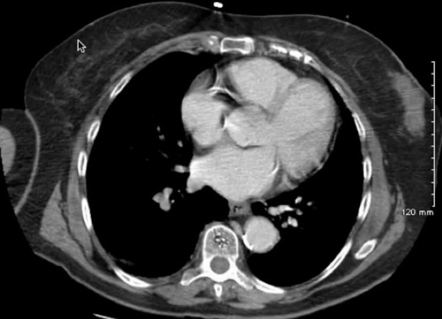 Diverticulose Colique et Diverticulite