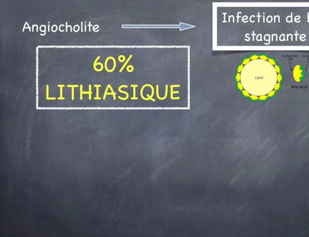 Lithiase Biliaire et Complications