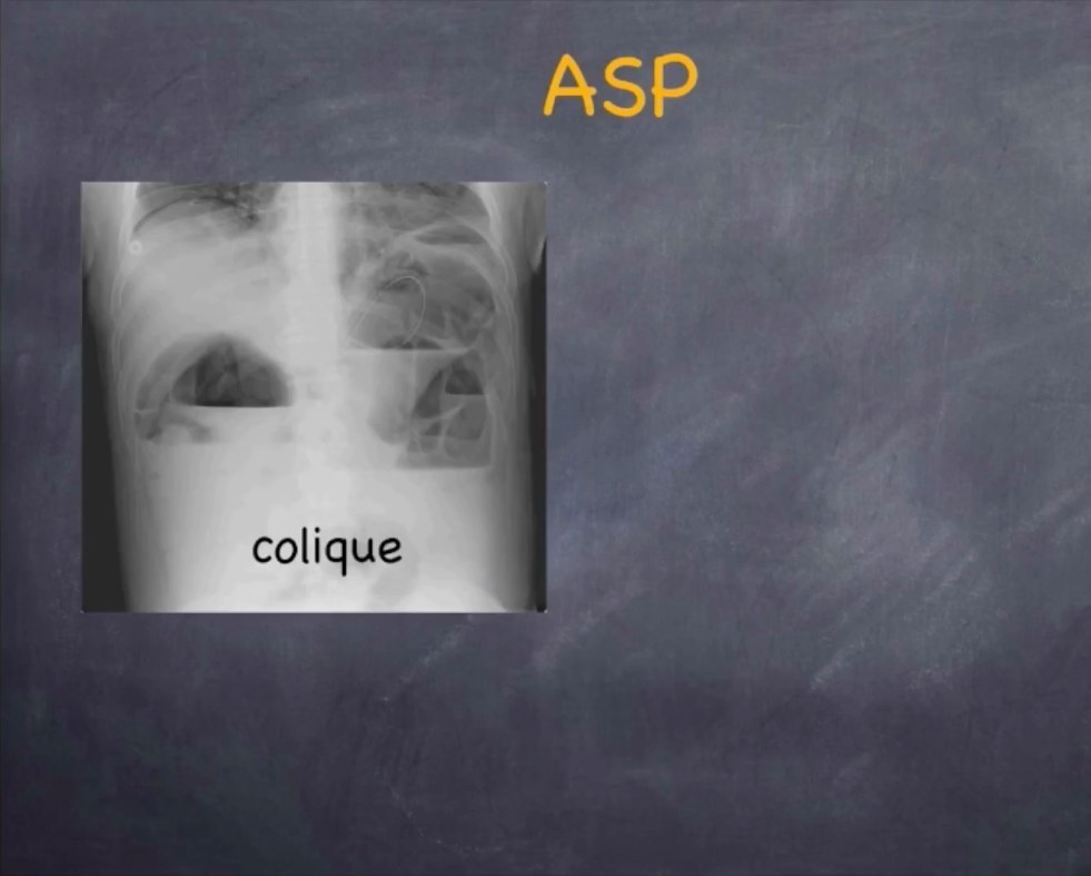 Syndrome Occlusif de l'Enfant et de l'Adulte