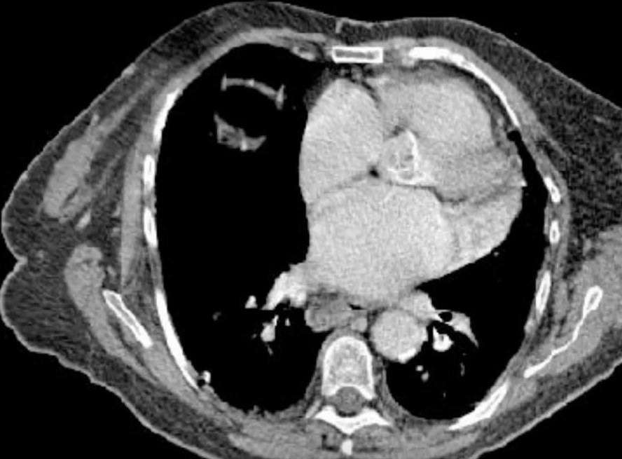 Syndrome Occlusif de l'Enfant et de l'Adulte
