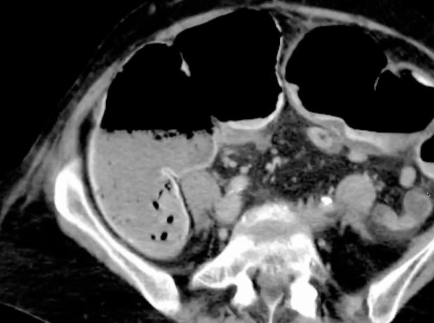 Syndrome Occlusif de l'Enfant et de l'Adulte