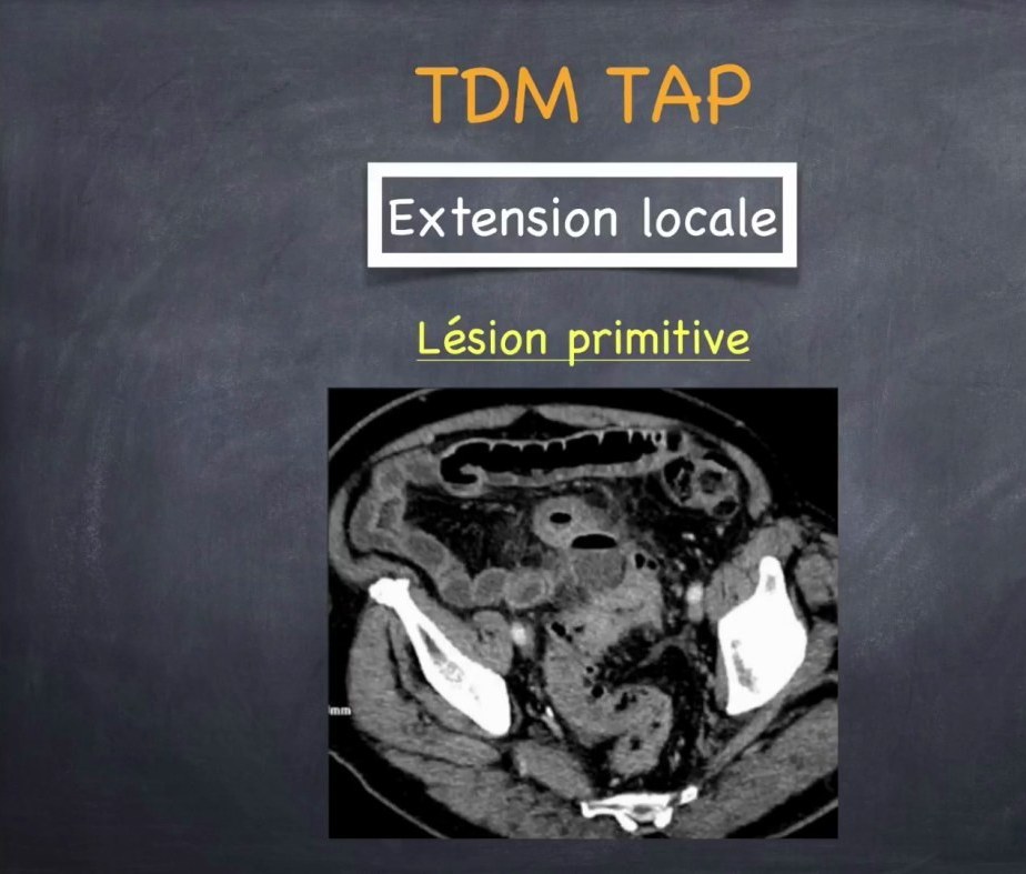 Tumeurs du Côlon et du Rectum