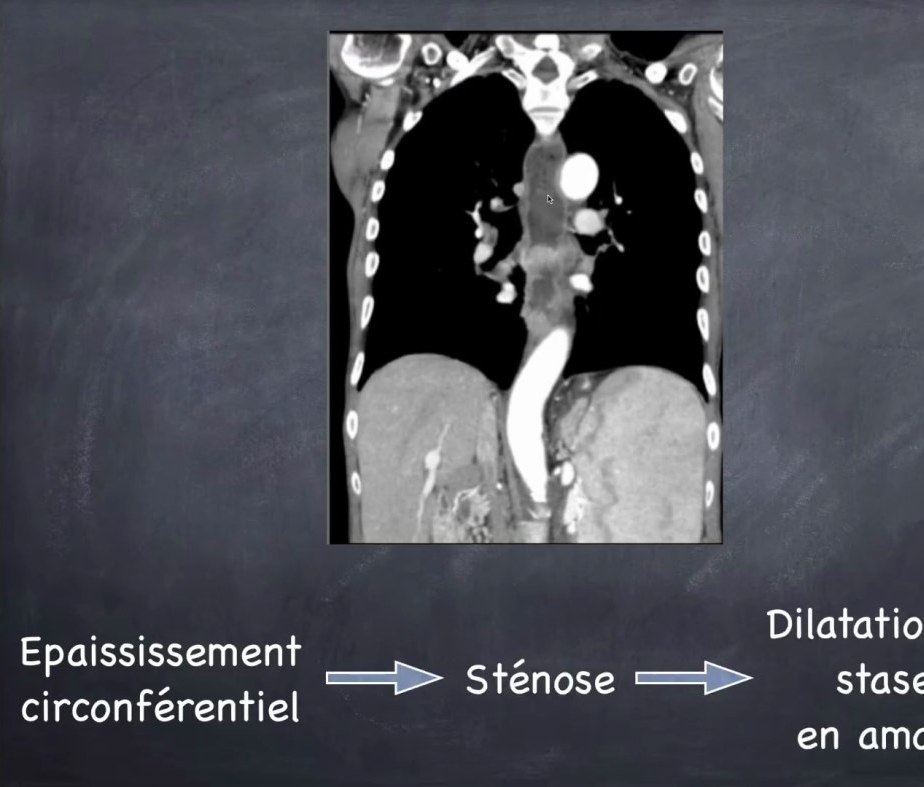Tumeur du Pancréas