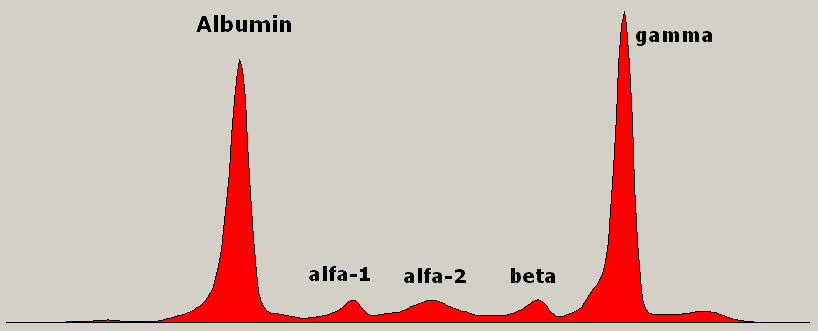 Électrophorèse des protéines (pic monoclonal)