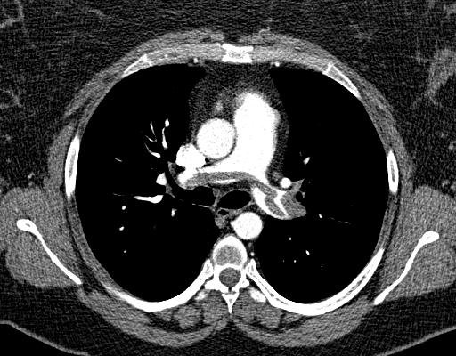 Embolie pulmonaire