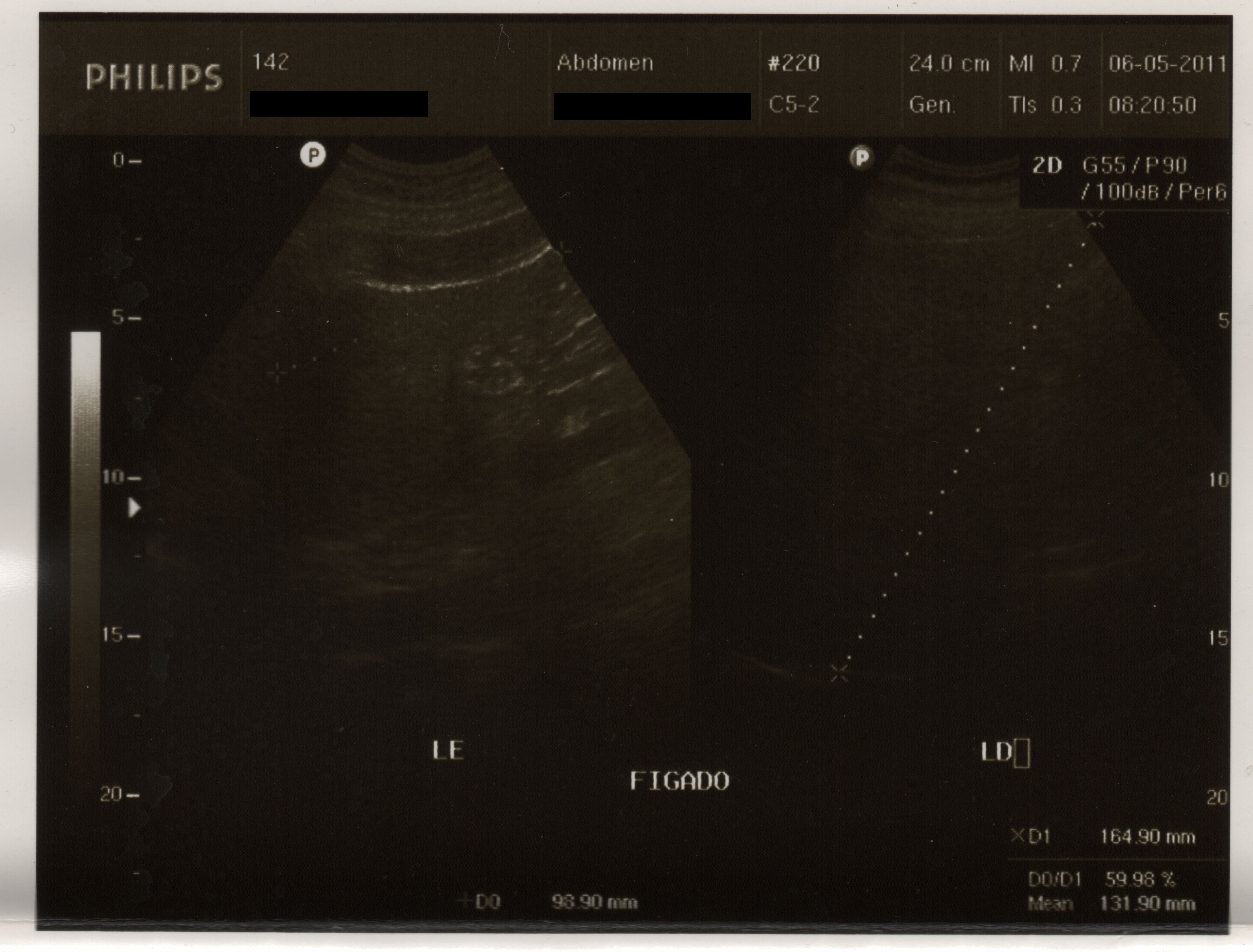 Palpation d'une hépatomégalie