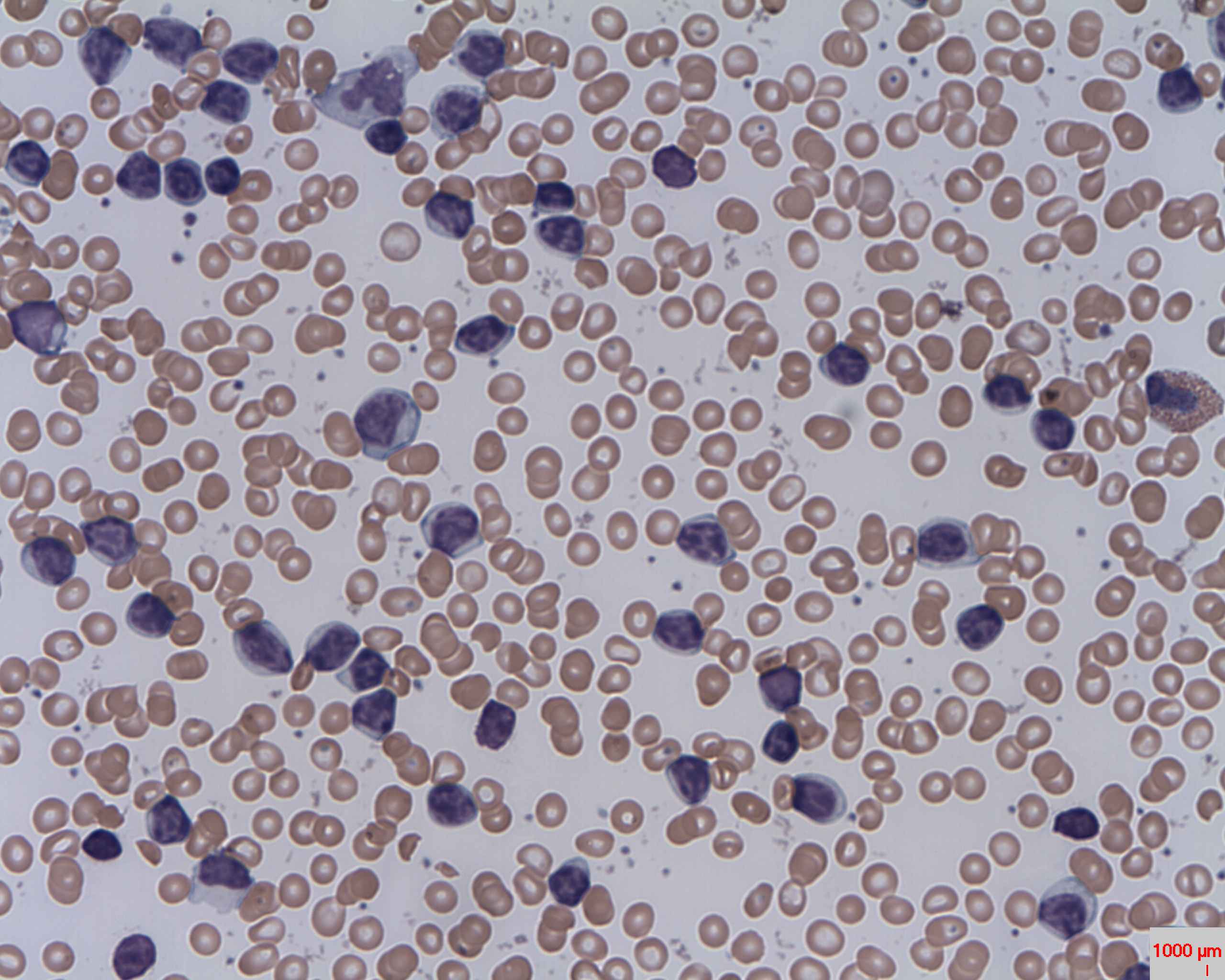 Leucémie lymphoïde chronique