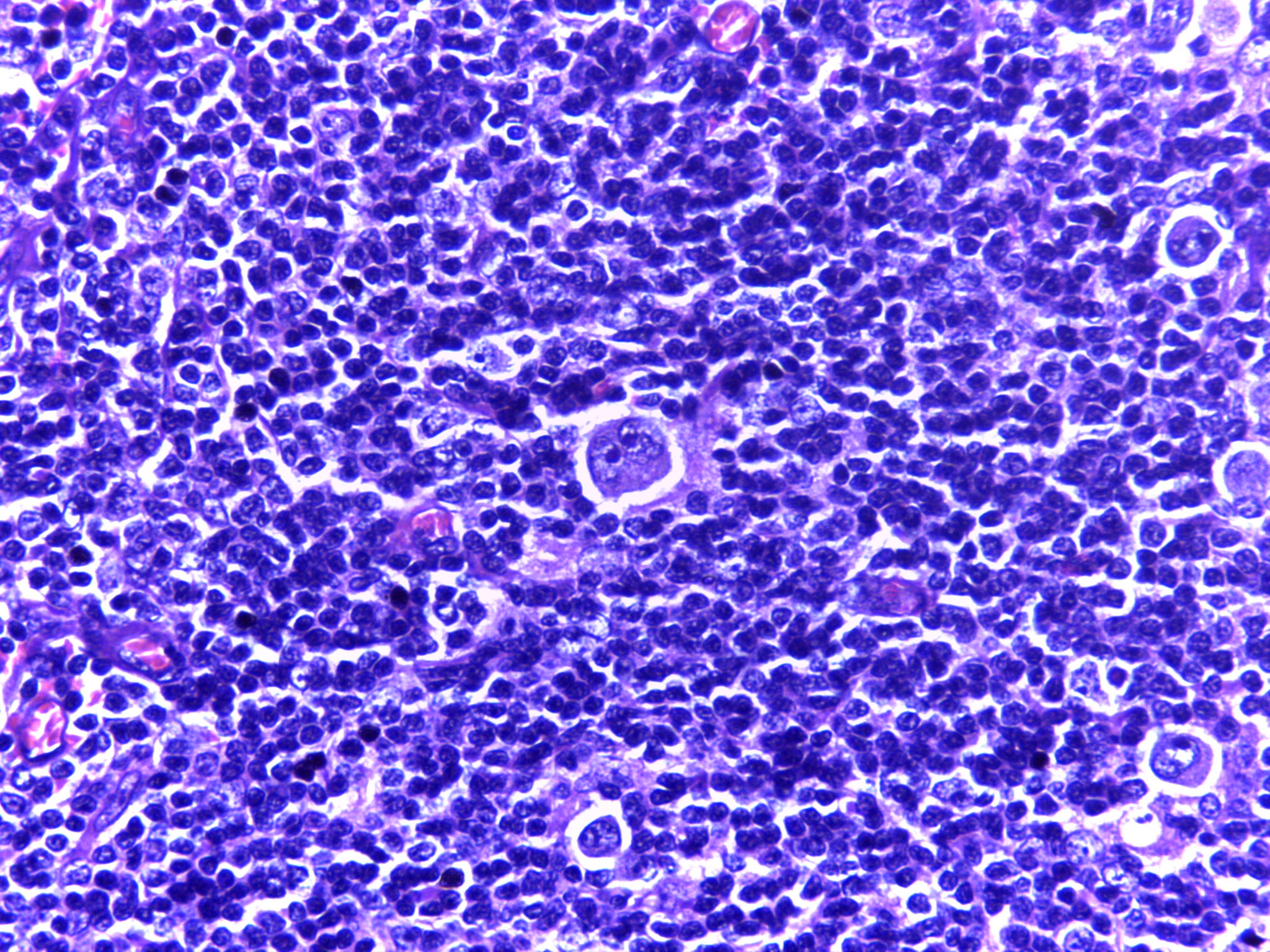 Lymphome de Hodgkin