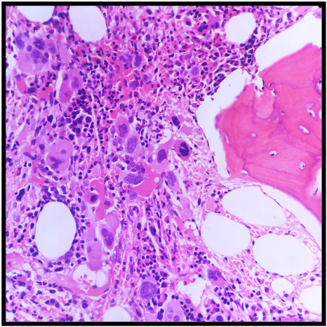 Myélofibrose primitive