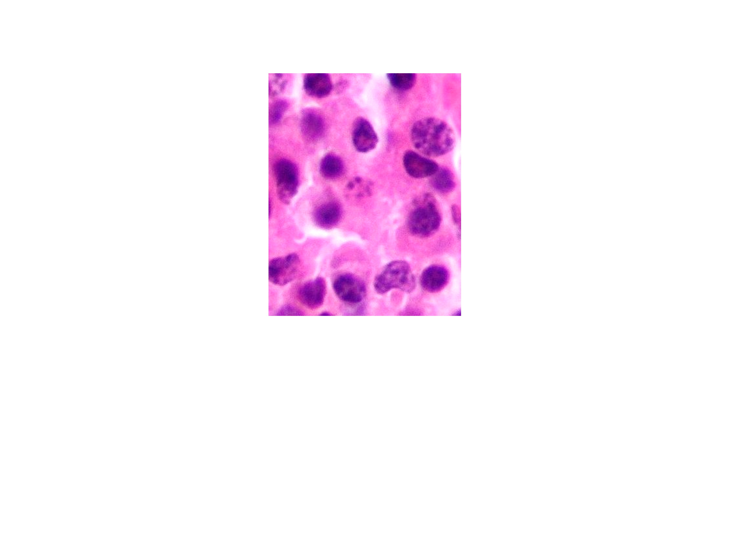 Myélome multiple