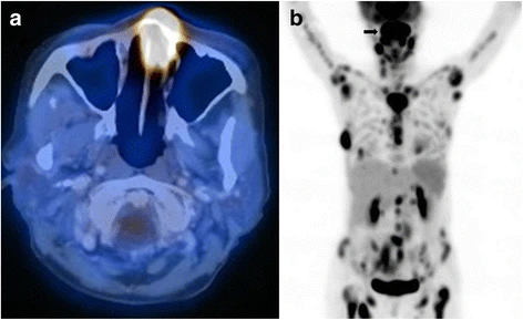 TEP-scanner (lymphome)
