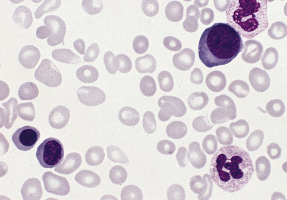 Polyglobulie de Vaquez