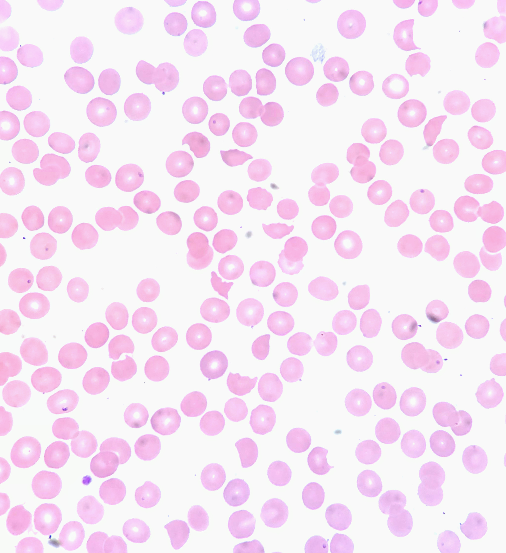 Purpura thrombotique thrombocytopénique