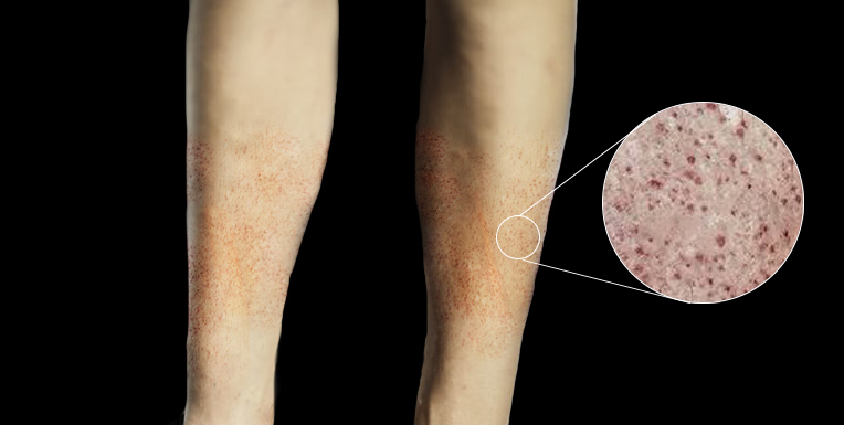 Purpura thrombopénique immunologique