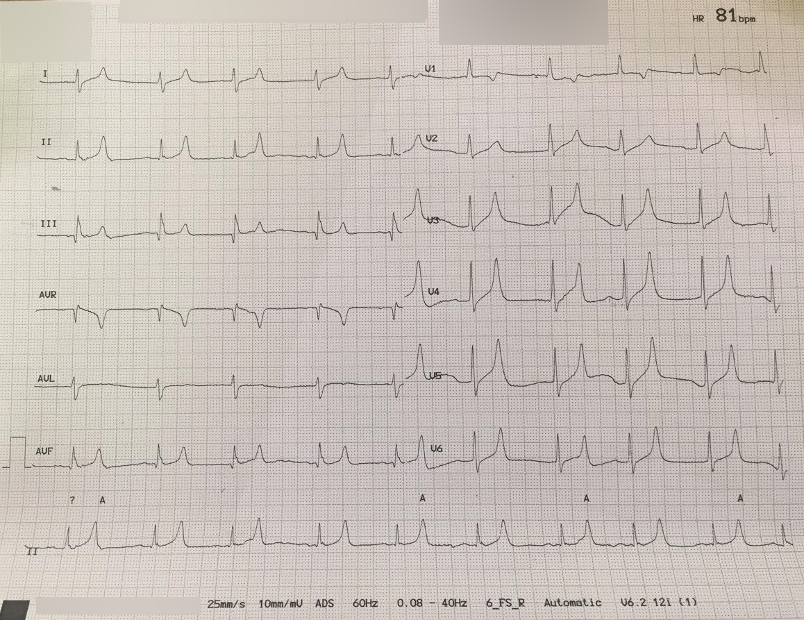 Syndrome de lyse tumorale
