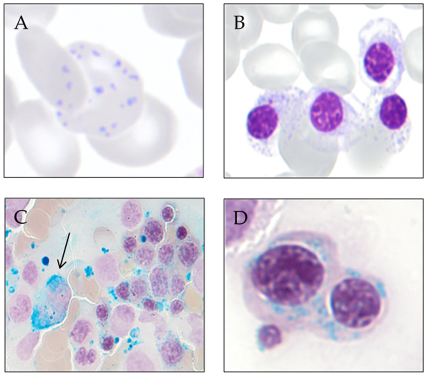 Syndrome myélodysplasique