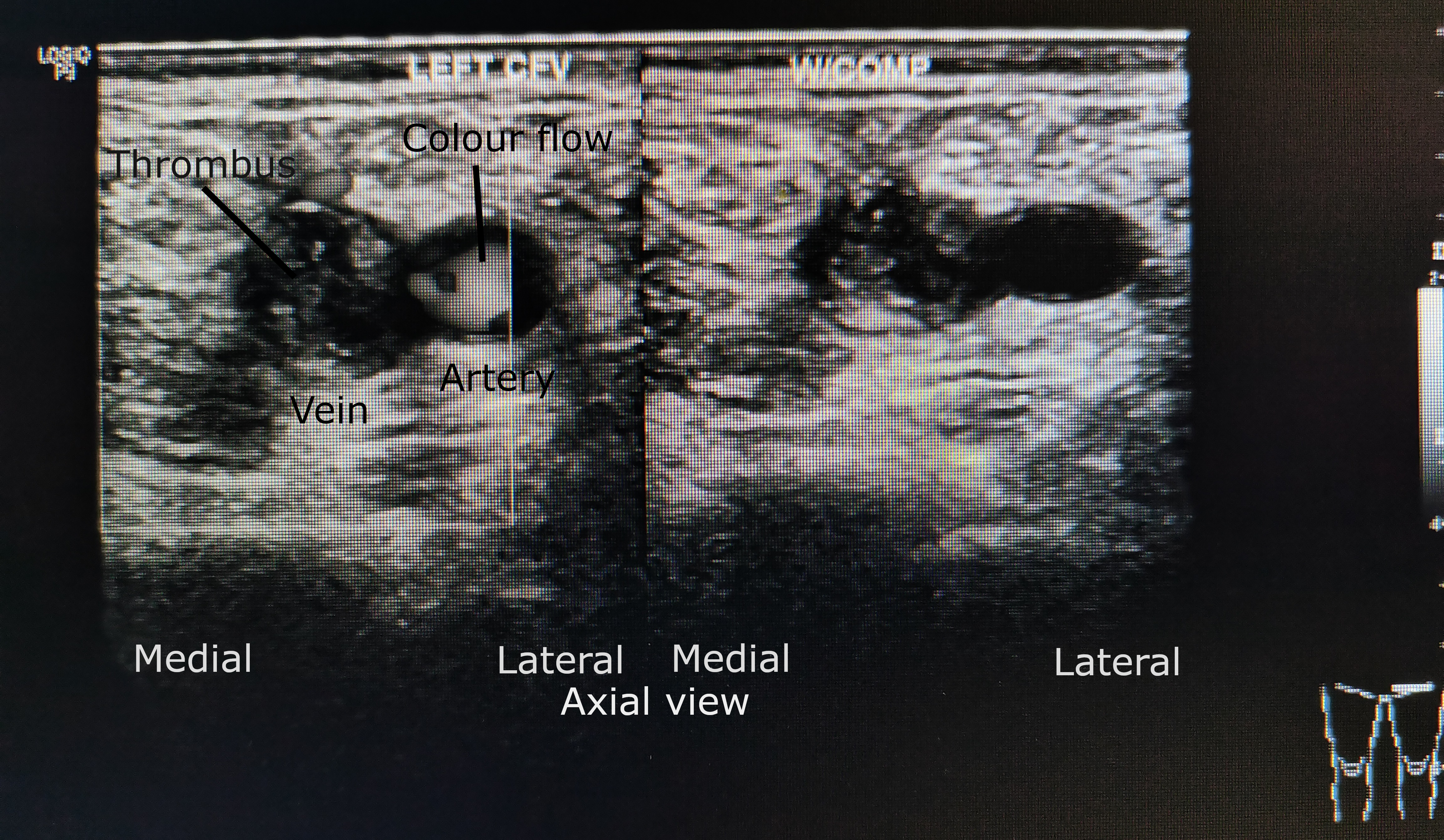 Thrombose veineuse profonde