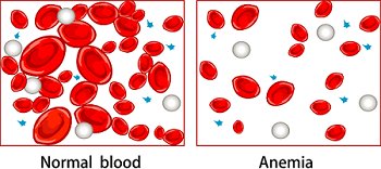 Anémie inflammatoire chronique