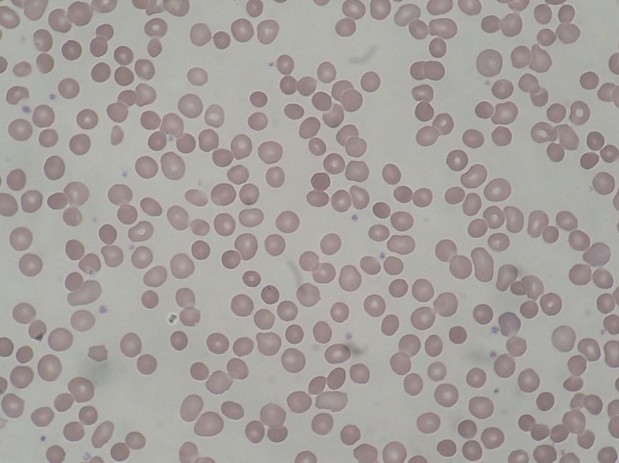 Sphérocytose héréditaire