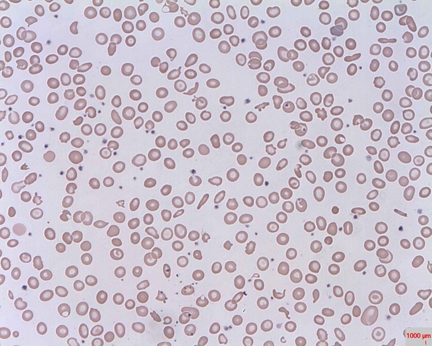 Schizocytes au frottis