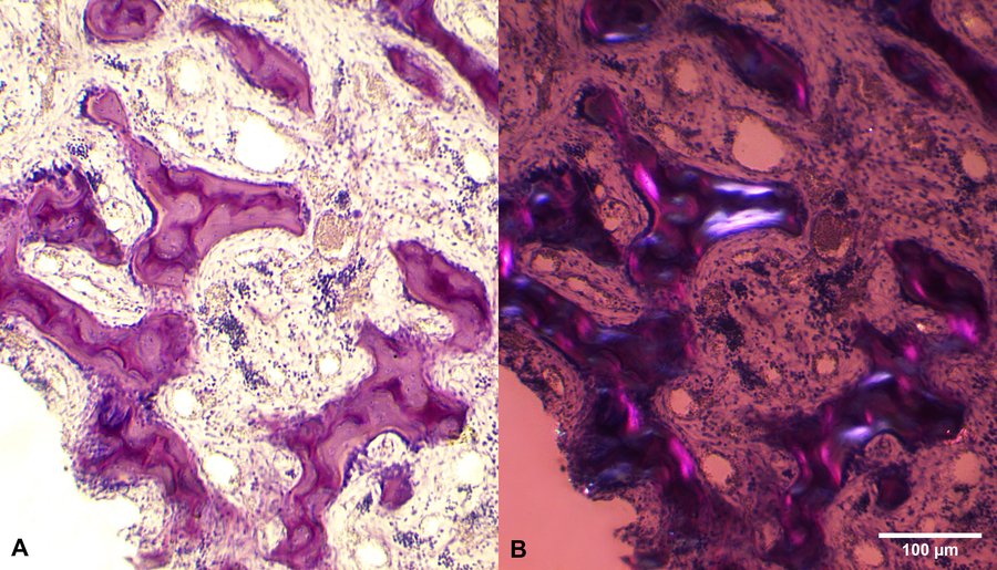 SMD hypoplasique et myélofibrose