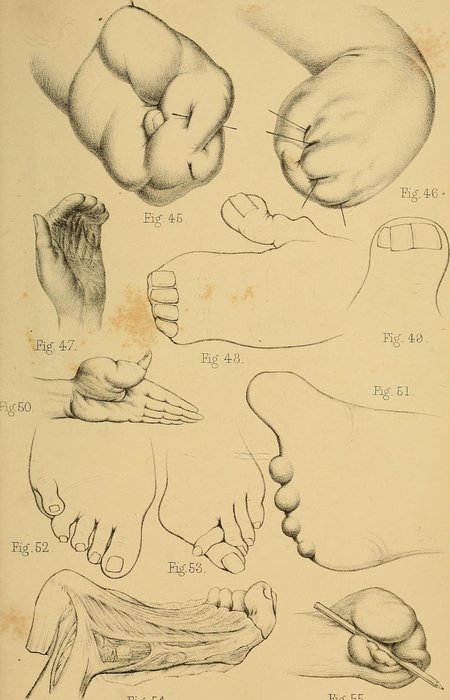Syndromes de prédisposition génétique