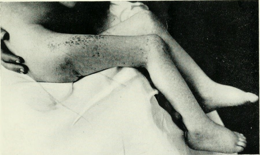 Atteinte cutanée, digestive et hépatique
