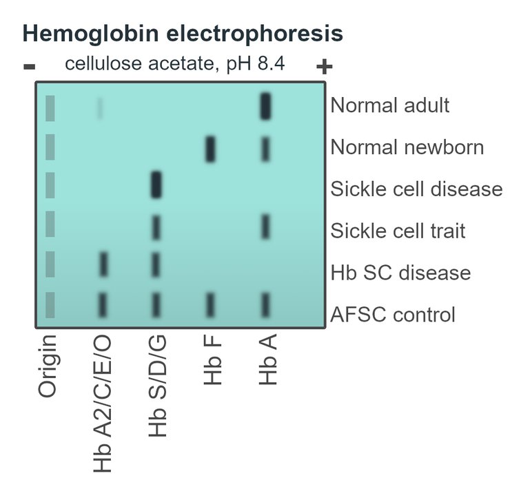 Électrophorèse et HPLC de l'hémoglobine